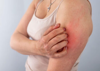 Smoke Residue Can Trigger Skin Diseases