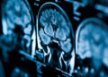 Study links vitamin D deficit to accelerated brain aging