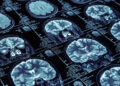 Brain imaging study links socioeconomic disparities in children’s sleep to reduced cortical thickness