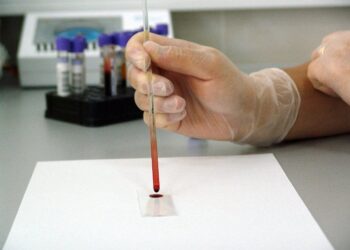 New Blood Test Differentiates Neurodegeneration in Alzheimer’s Disease From Other Dementias