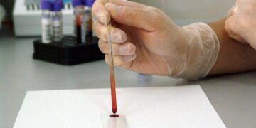 New Blood Test Differentiates Neurodegeneration in Alzheimer’s Disease From Other Dementias