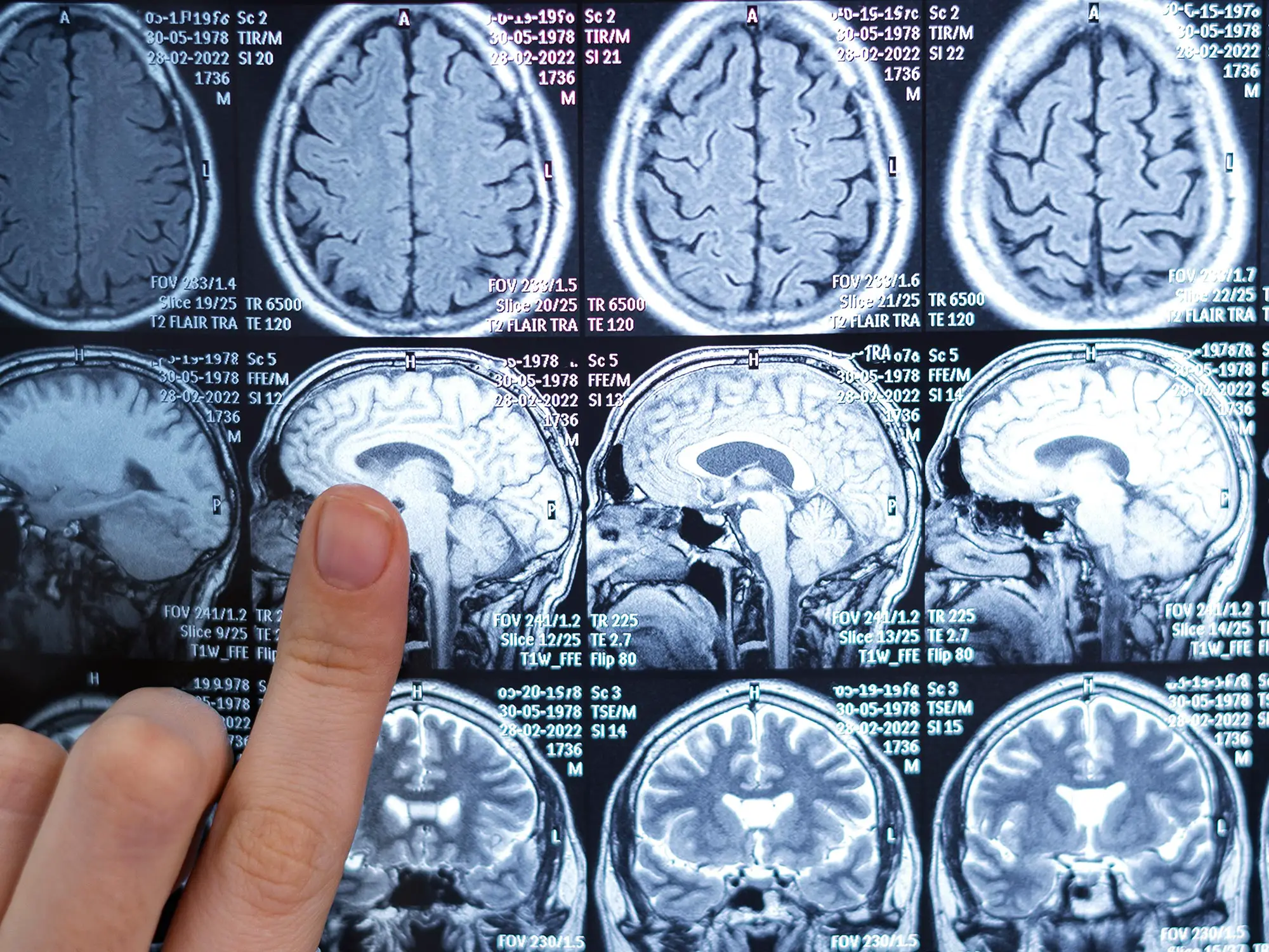 New Drug Delays Progression of Deadly Brain Cancer