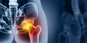 Hip Replacements Are Lasting Far Longer Than Doctors Once Thought